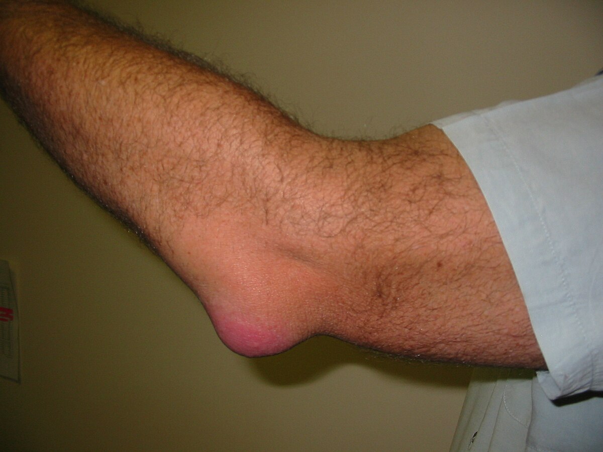 28 Fakten Über Bursitis
