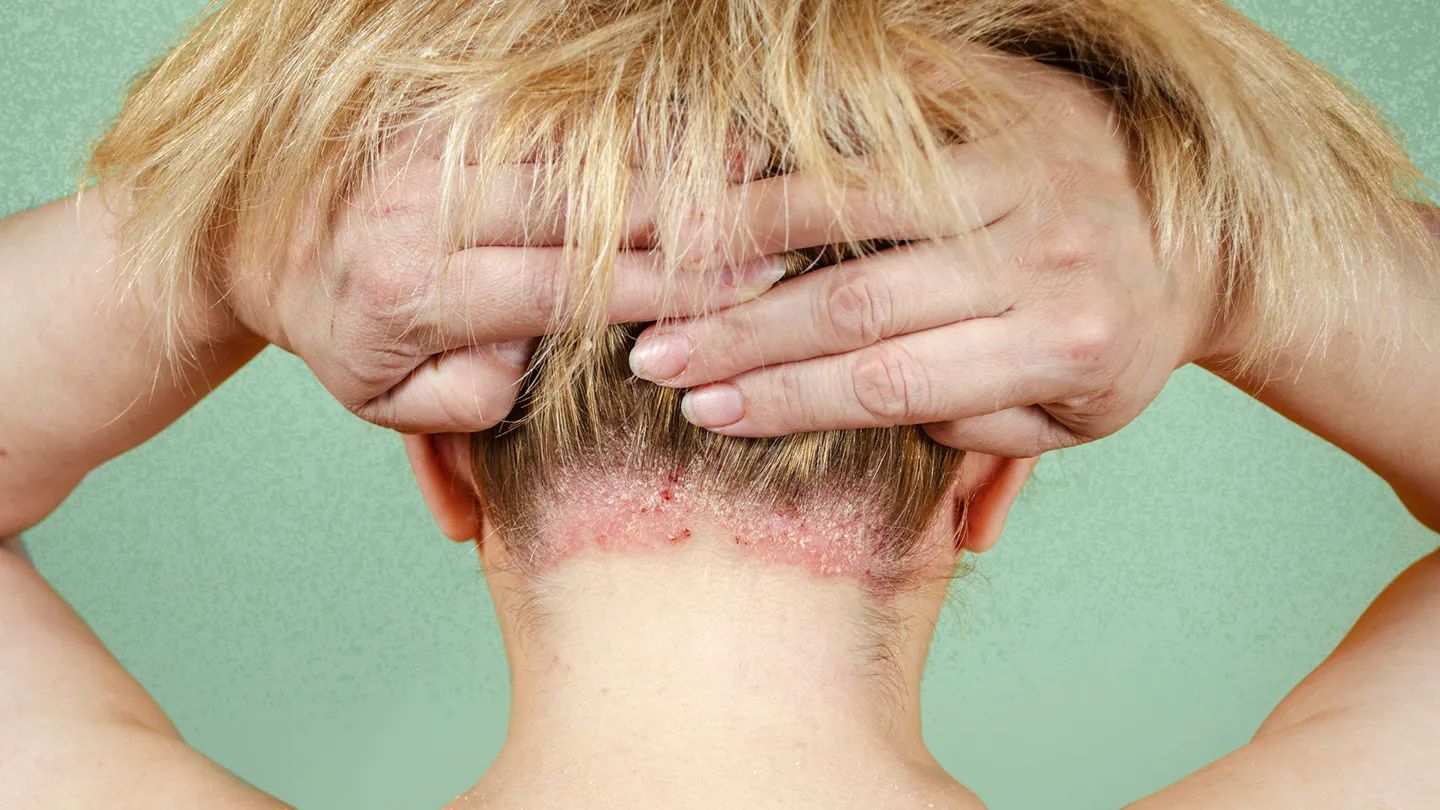 40 Fakten Über Psoriasis
