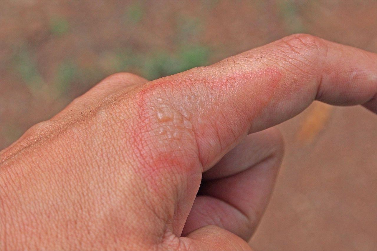 26 Fakten Über Impetigo