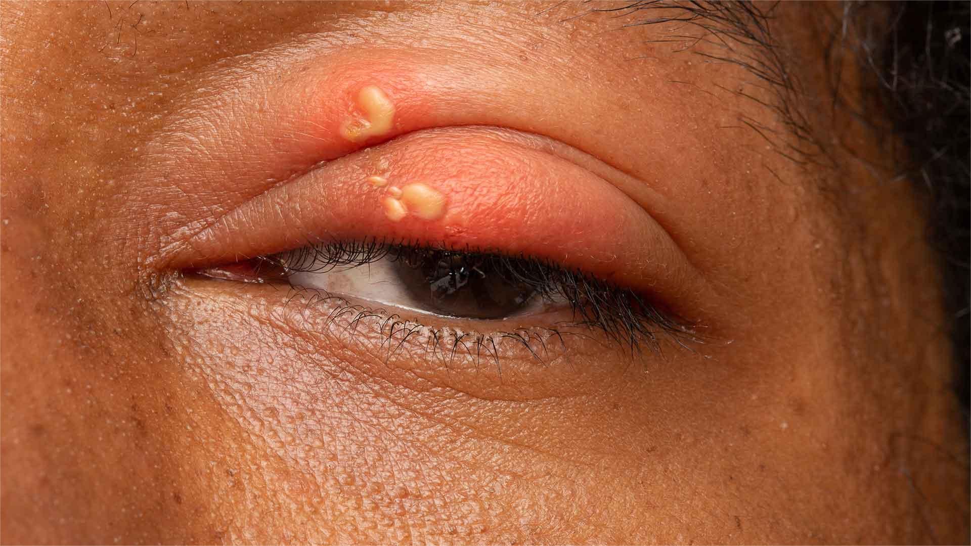 33 Fakten Über Herpes